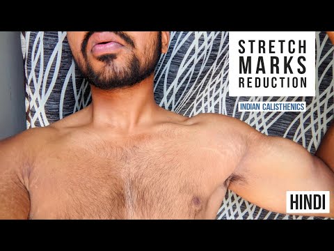 stretch marks men removal