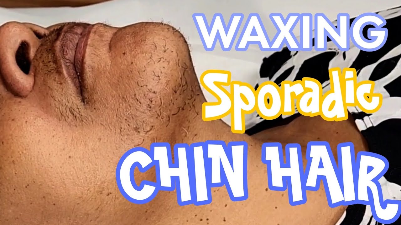 Waxing Sporadic Wild Chin Hair Hirsutism Youtube