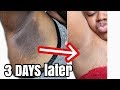 LIGHTEN UP YOUR ARMPITS IN LESS THAN 3 DAYS WITH THIS SOLUTION