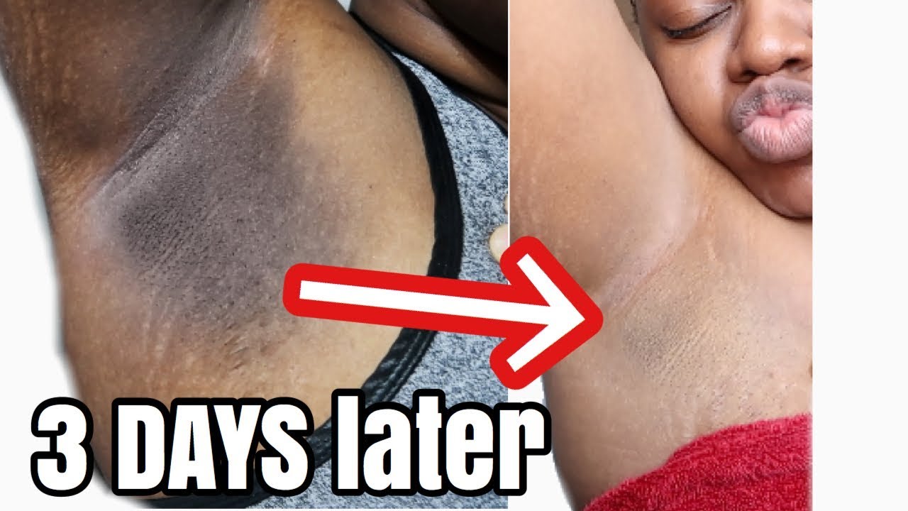 Lighten Up Your Armpits In Less Than 3 Days With This Solution