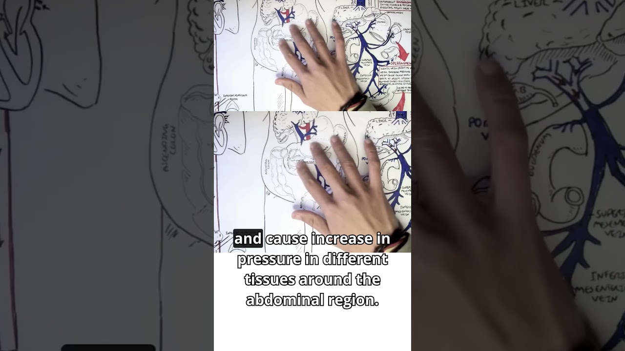 Gastroenterology Insights I: Portal Hypertension Explained #gastroenterologyinsights #ascites #meded