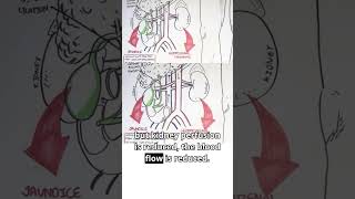 Gastroenterology Insights I: Portal Hypertension Explained #gastroenterologyinsights #ascites #meded