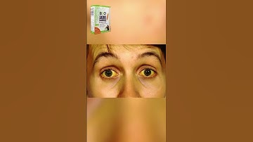 [Giải độc gan Bio Foie] 7 Dấu hiệu cảnh báo bệnh gan đang đi vào giai đoạn nặng