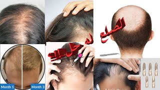 الصلع الوراثي - كل ماتود معرفته عن تساقط الشعر نتيجة الوراثة أو تكيس المبايض أو خلل هرموني