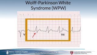 "Wolff-Parkinson-White Syndrome" by Dr. Gary Dhillon for OPENPediatrics screenshot 5