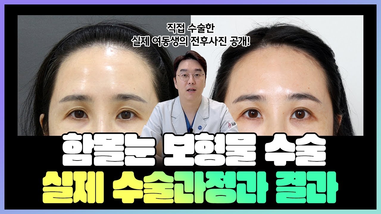 가족에게 권하는 수술, 실제 동생의 함몰눈 교정술 전후사진 공개😊