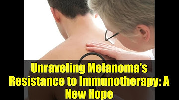 Unraveling Melanoma