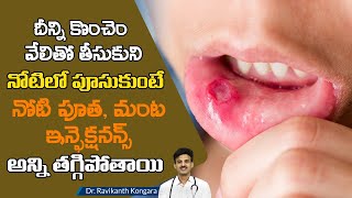 How to Reduce Mouth Ulcer | Burning Mouth | Candid | Riboflavin | Dr. Ravikanth Kongara