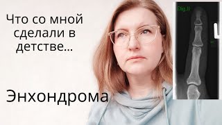 Vlog🇩🇪ОЧЕНЬ БОЮСЬ ОПЕРАЦИИ/Что со мной сделали в детстве😪 #энхондрома #123go