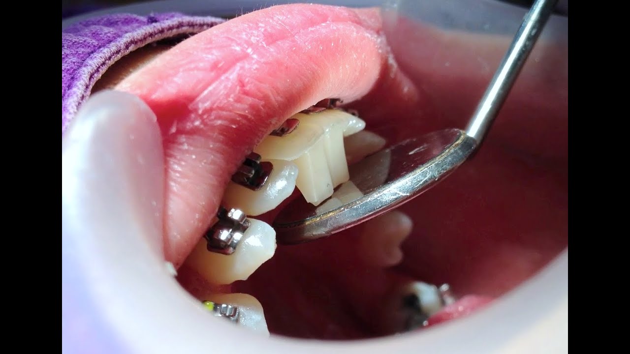 Orthodontics Dental Braces with Bite Turbos YouTube