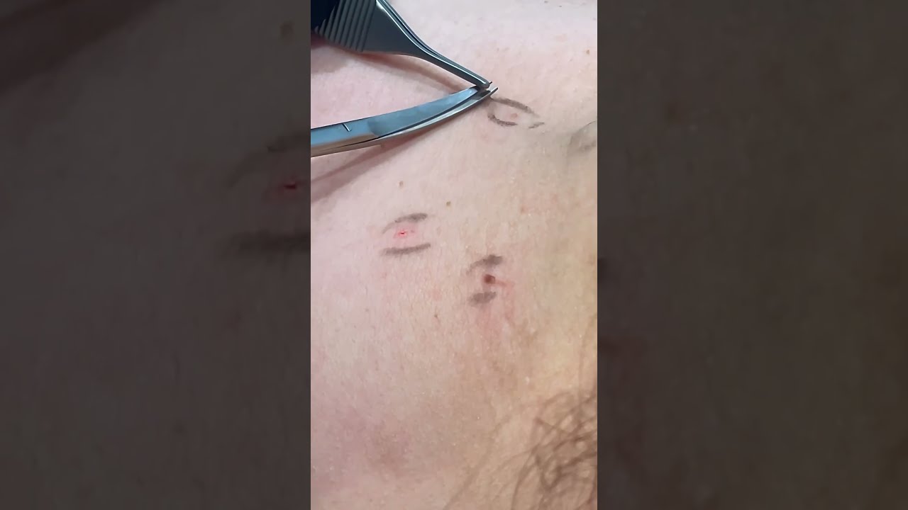 How I Safely Remove Skin Tags 