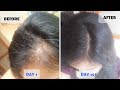 OMG ! 15 Days Hair Growth Miracle Treatment | Grow Long Thicken Hair | 100% works