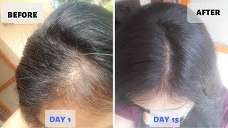 OMG ! 15 Days Hair Growth Miracle Treatment | Grow Long Thicken Hair | 100% works screenshot 3