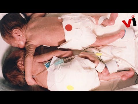 Baby Had No Chance,But When Nurse Puts Twin Next To Her To Say Goodbye, A Miracle Happens