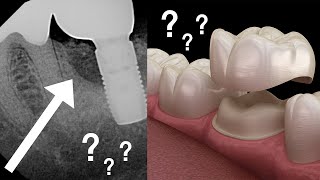 Does LANAP Treat Bone Loss Can You Get A Cavity Under A Crown Dr. Nemeth Q&A!