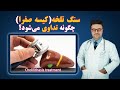 سنگ تلخه کیسه صفرا چگونه تداوی میشود داکتر قیس نیکزاد