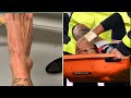 Neymar jr  injury his treatment 😥2021