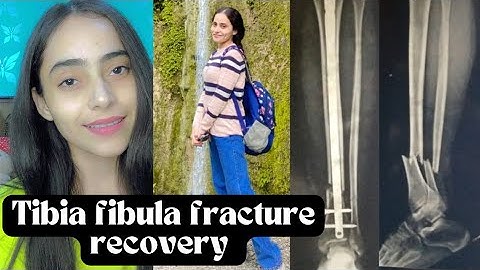 tibia fibula fracture || 2 months recovery. I can