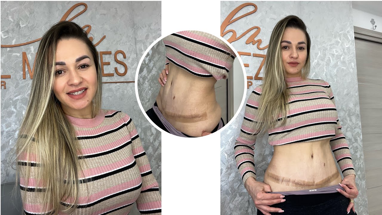 Relato da minha ABDOMINOPLASTIA+LIPO após 8 meses , como está minha ...