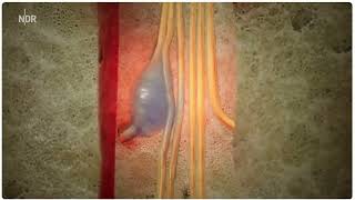 Symptomatic Tarlov Cyst Animation