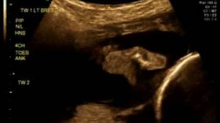 20_Weeks_2a.avi