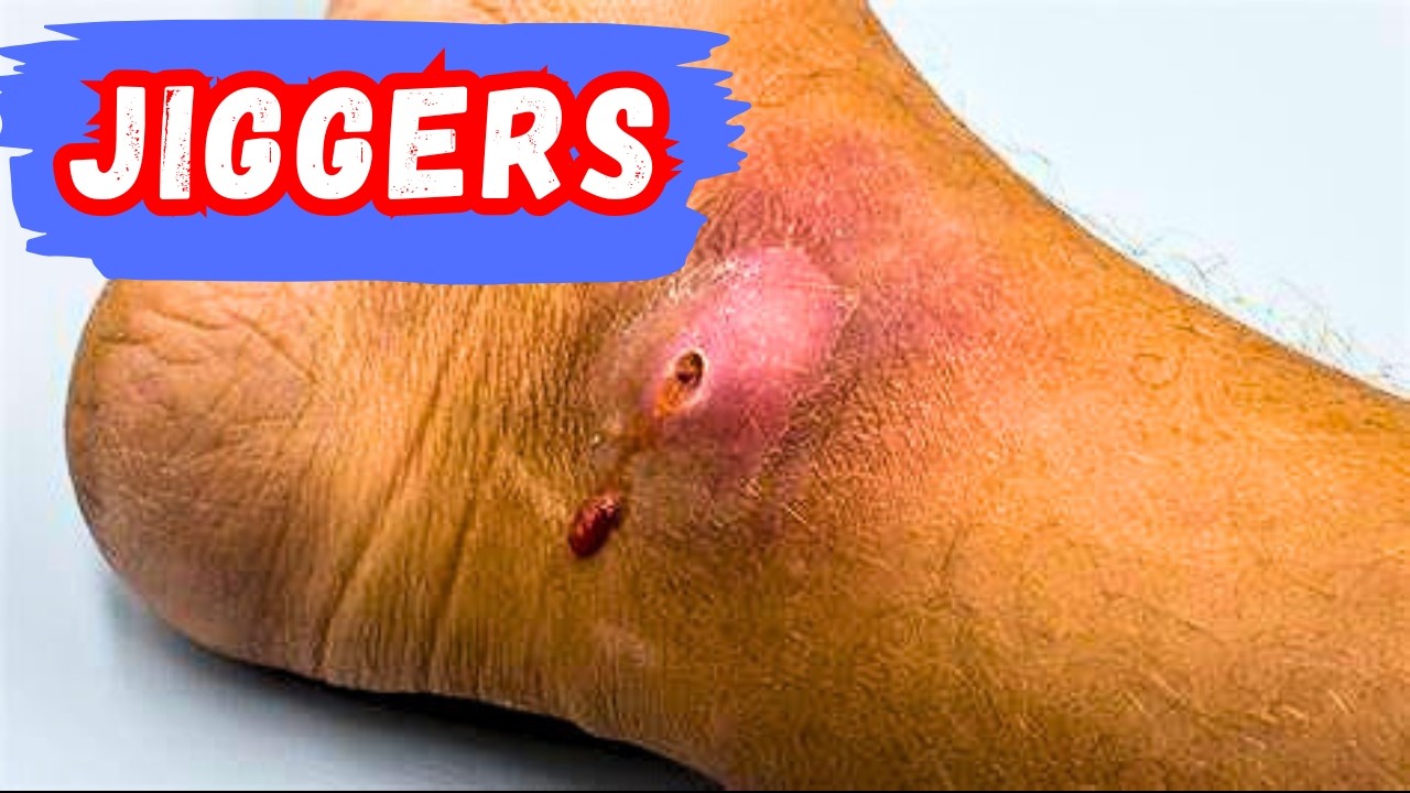 What Happens When Jiggers Spread in the Body | My Father’s Painful ...