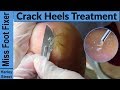 The right way to remove heel callus  - FULL TREATMENT