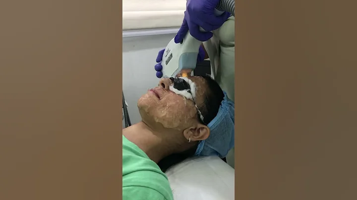 Cure your rosacea and acne with photofacial