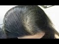 Hair Back for hair loss review -   االعلاج الجذري لتساقط الشعر و الصلع