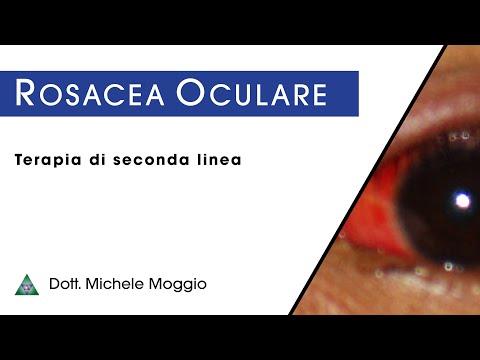 ROSACEA OCULARE - Terapia di seconda linea per la cura della rosacea oculare