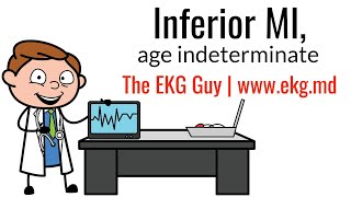 Inferior Mi age Indeterminate On Ekg  Ecg L The Ekg Guy  Wwwekgmd