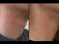 HOW TO CURE RAZOR BURN BUMPS ON NECK & LEGS!
