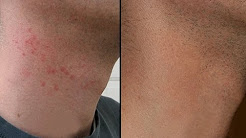 HOW TO CURE RAZOR BURN BUMPS ON NECK & LEGS!