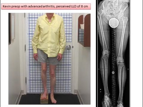 Video: Deforming Arthrosis Of The Knee, Hip Joints - Treatment