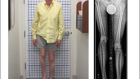 Total Hip Replacement for Arthritis, Deformity & Leg Length Discrepancy