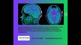 DTI Diffusion Tensor Imaging is an advanced MRI technique that maps the brain's white matter