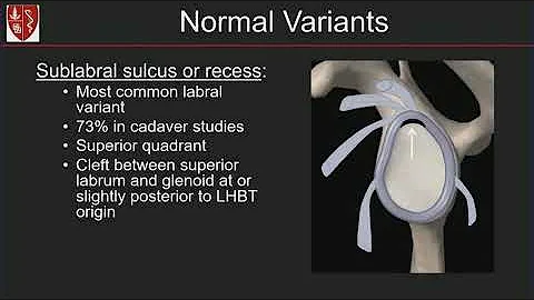 Imaging of the Glenoid Labrum: Location Matters!  ...