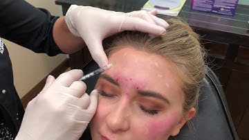 Allergan - Botox Injections