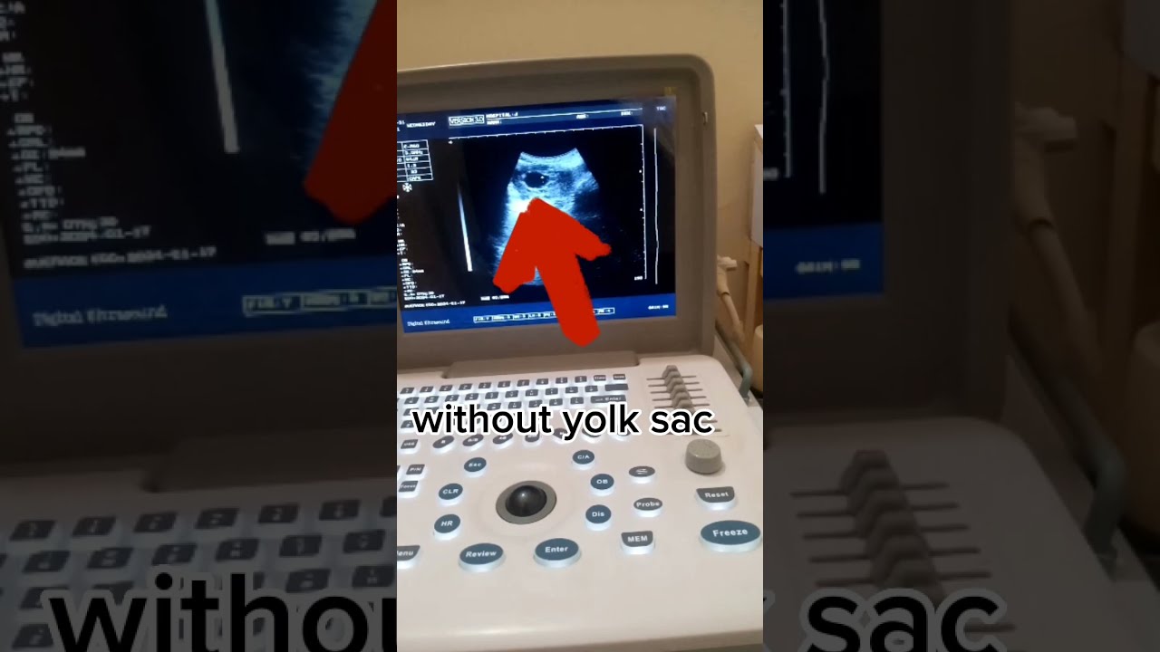 Gestational Sac Without Yolk Ultrasound