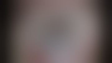 Anterior Chamber IOL, Dislocated Single-Piece IOL | Advanced IOL Fixation Techniques, by David Chang