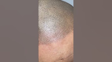 How to do Micropigmentation? #scalpmicropigmentation