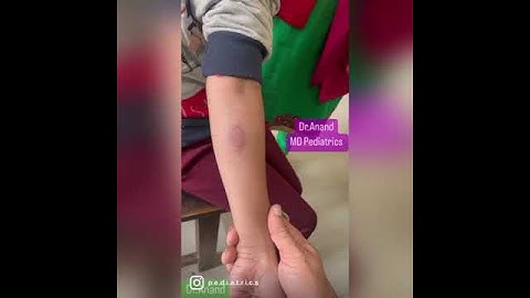 Mantoux Test | is this test positive? #shorts