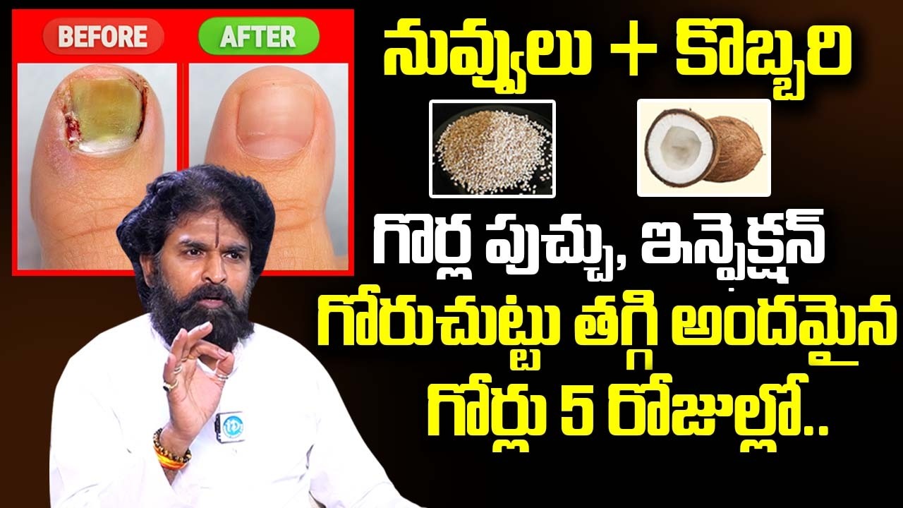 నువ్వులు + కొబ్బరి పుచ్చిపోయినా గొర్లు, గోరుచుట్టు మాయం.! || Goru Chuttu Home Remedy || Vikramaditya