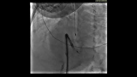 Device deployment procedure