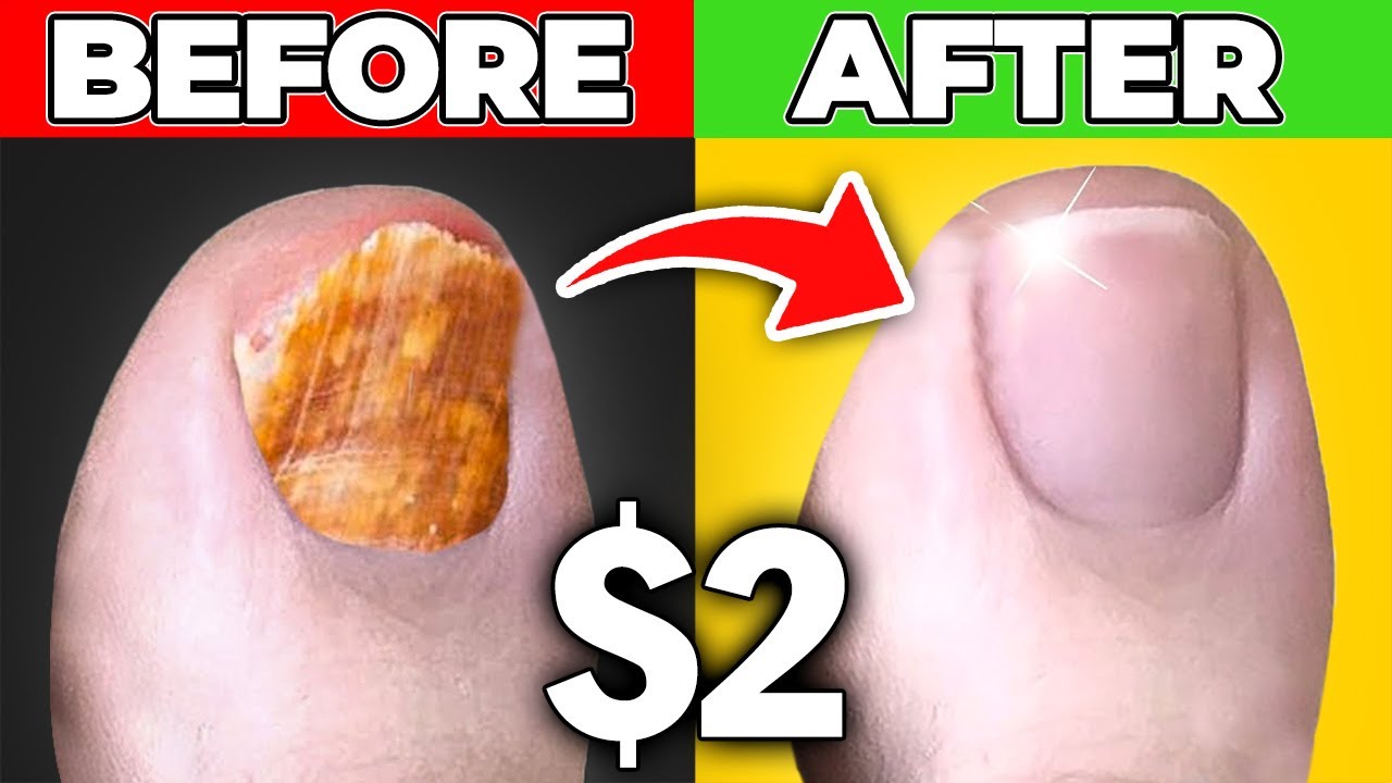 Toe nail fungus treat naturally at home