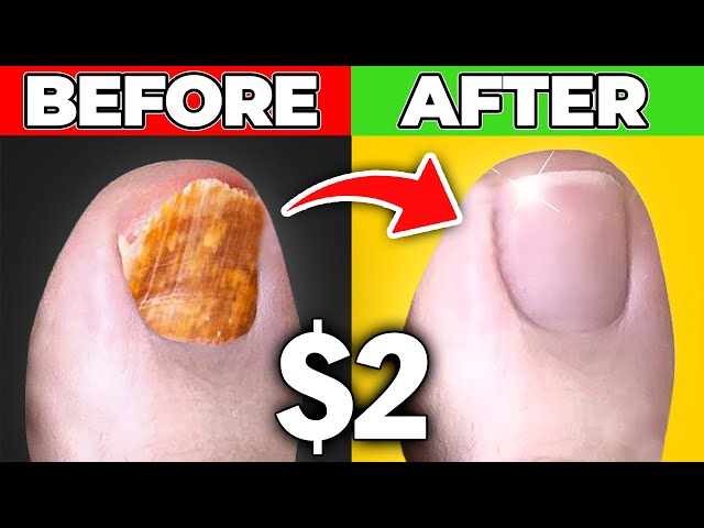 A Guide to Common Types of Toenail Fungus - Arizona Foot Doctors