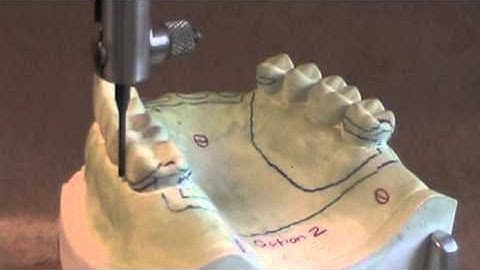 12 Class IV Path of Insertion