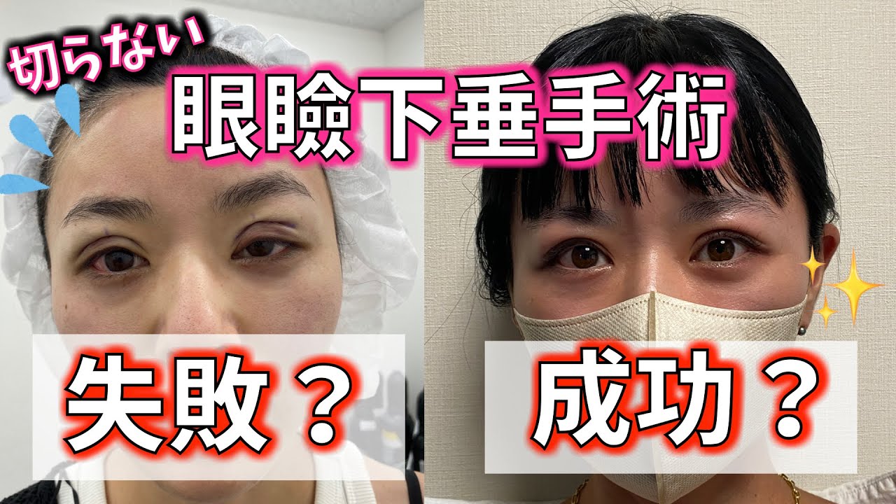 眼瞼 下垂 失敗 画像