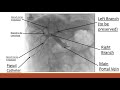 MSC Portal Vein Embolization