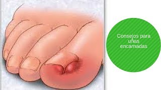 Consejos para prevenir las uñas encarnadas